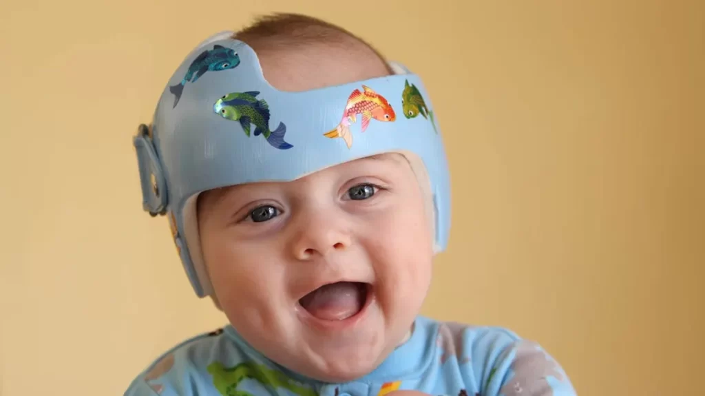 Ảnh mô tả phục hồi chức năng trẻ nhỏ điều trị chỉnh hình hộp sọ